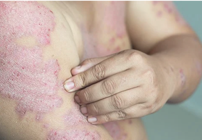 Psoriasis