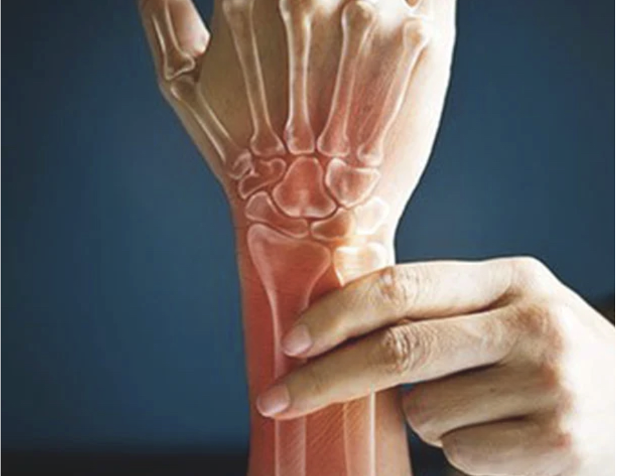 Rheumatoid Arthritis